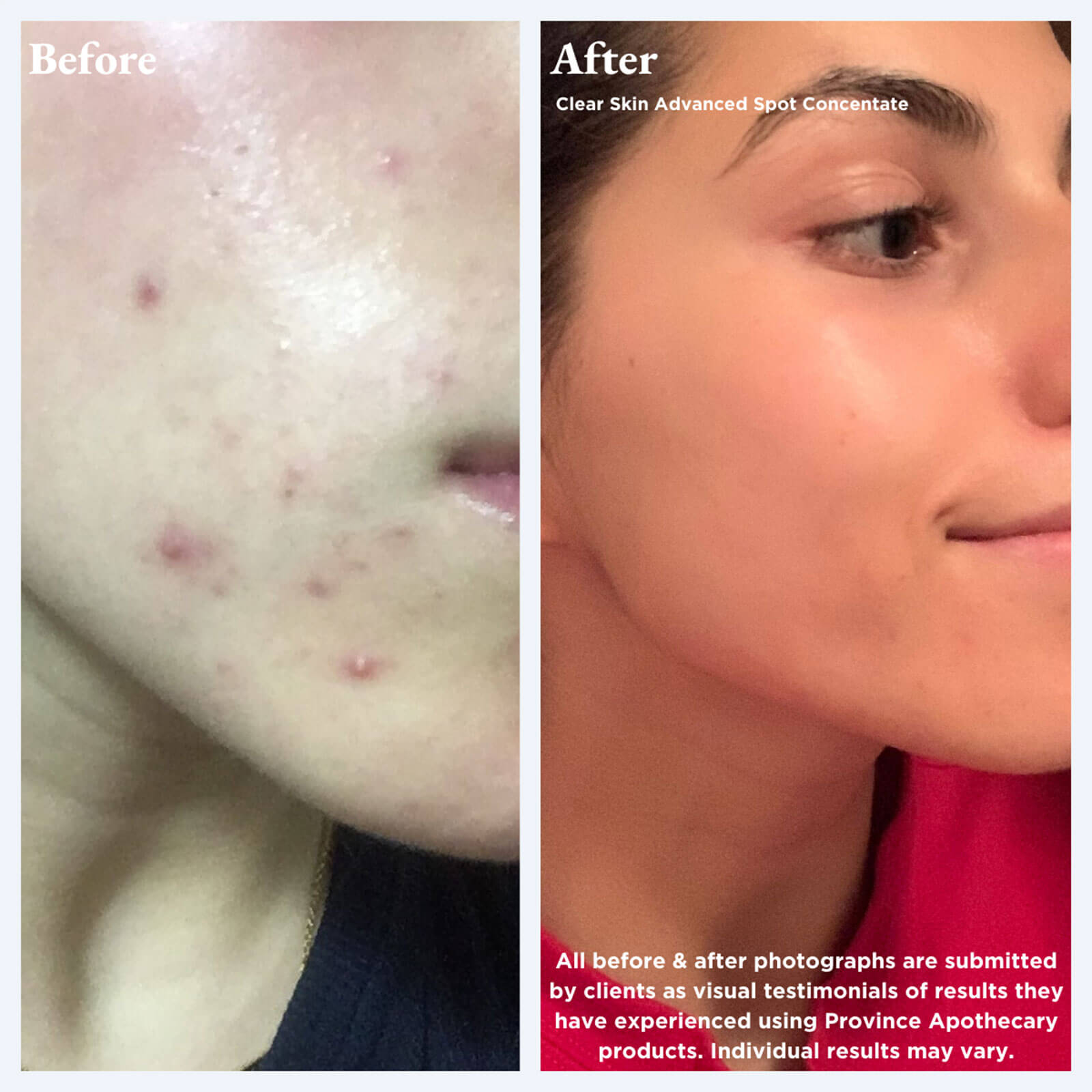 Clear Skin Advanced Spot Concentrate - Before & After
